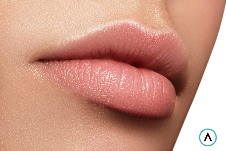 Lip Fillers