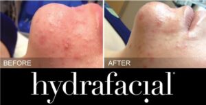 HydraFacial acne before and after