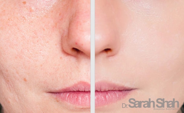 facial Acne Treatments