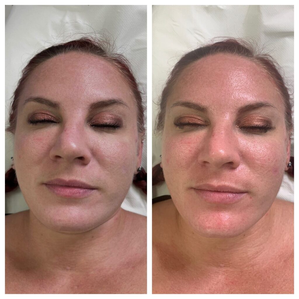 hydrafacial results