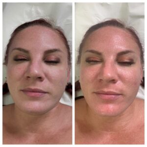 hydrafacial results