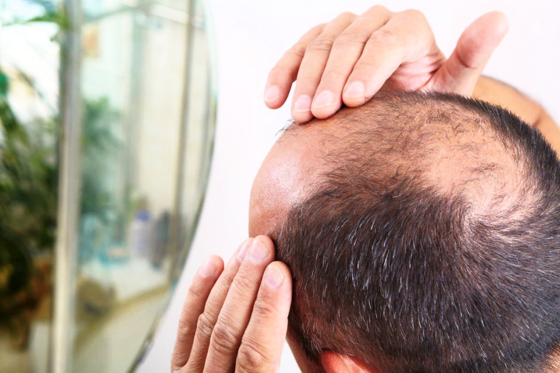 8 Simple Ways To Treat Hair Loss At The Temples