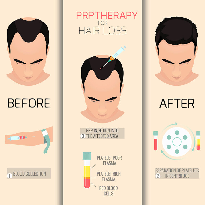 prp treatment for hair loss 20s