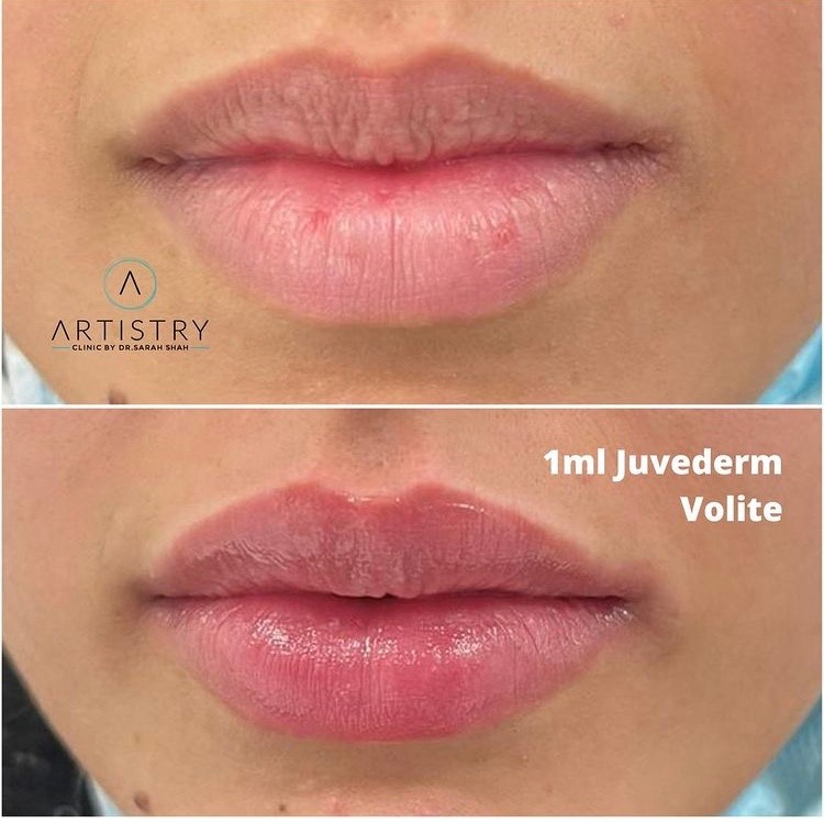 Results of the treatment after injecting one ml of Juvederm Volite on the lips.