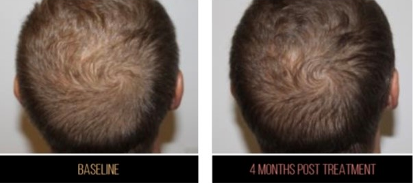 A male head shows the results of hair growth after four months of the treatment.