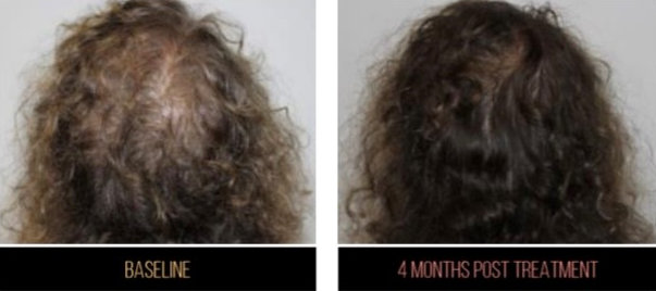A woman's skull demonstrates the growth of the hair four months after the procedure.