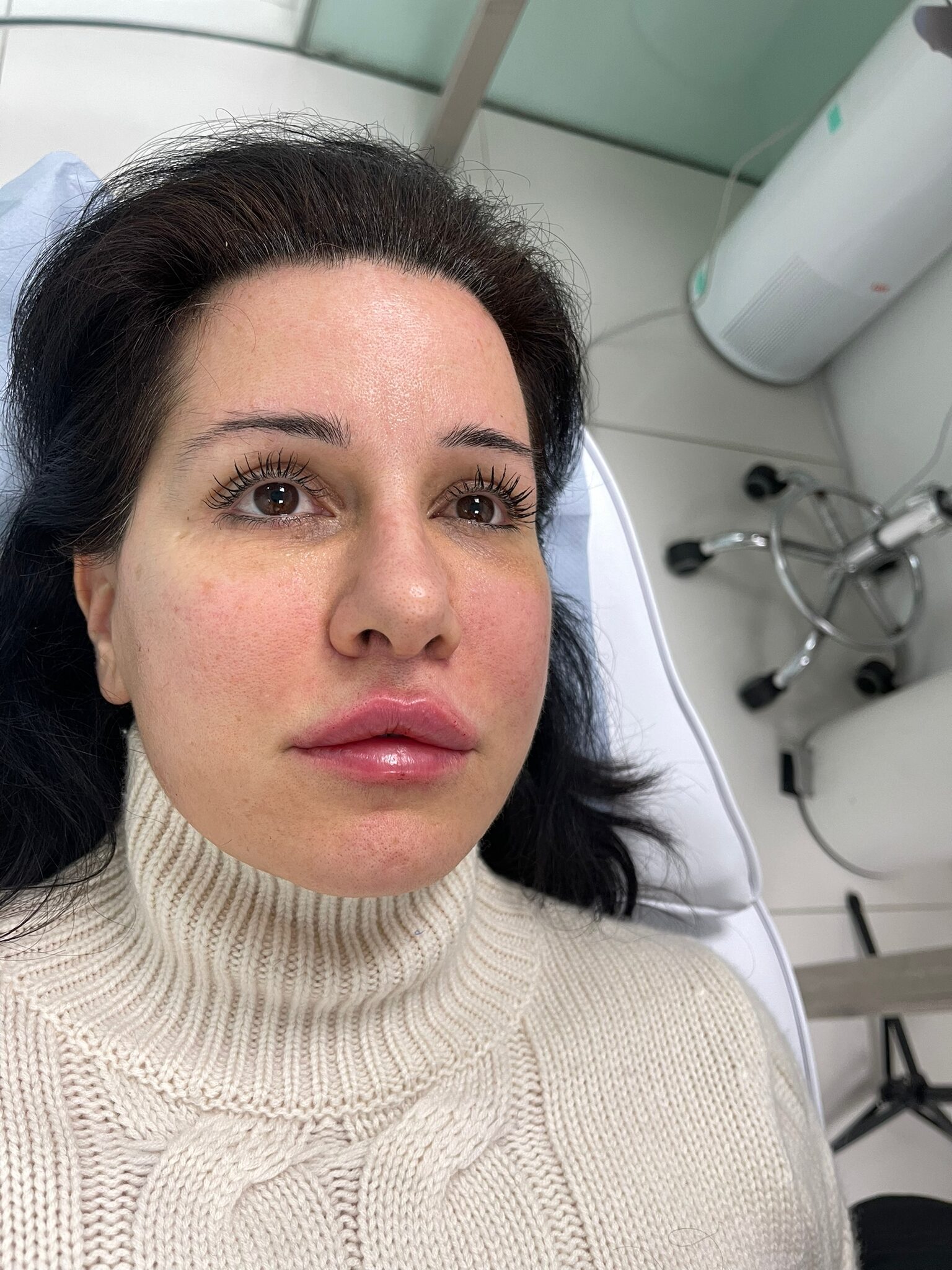 A woman with natural-looking lips after having a lip filler treatment.