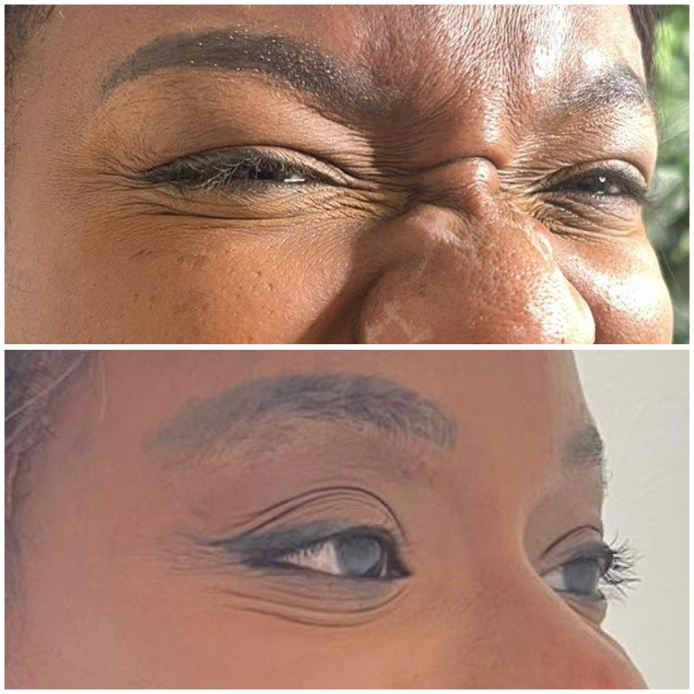 Before & After Image for Botox treatment