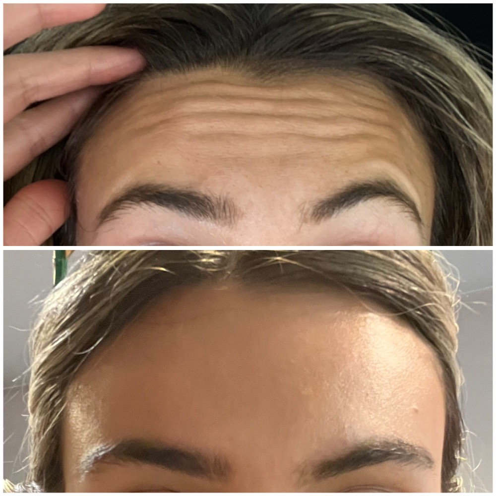 Before & After Image Botox treatment