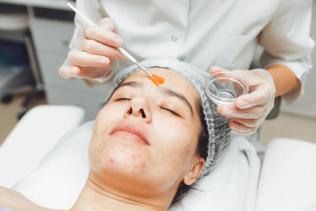 A woman is currently undergoing a chemical peel treatment to minimize the visibility of her scars.