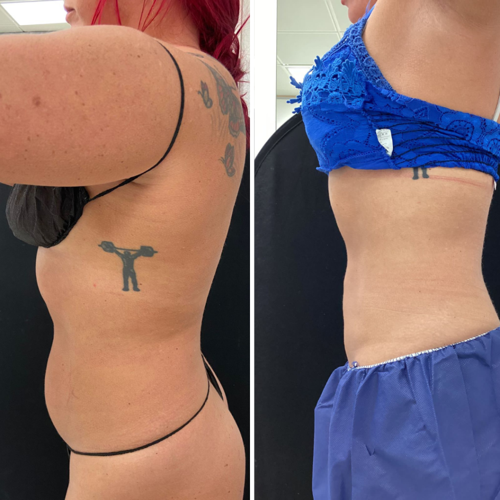 A woman showed the results before and after the treatment using the cryolipolysis method.