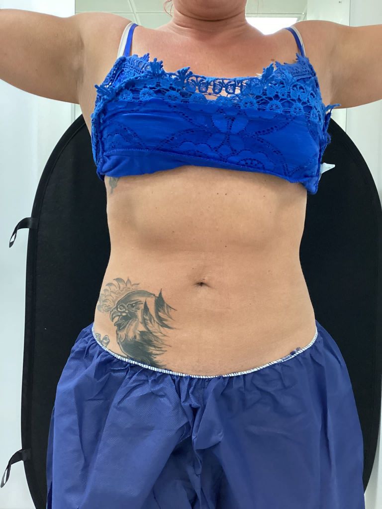 Natalie Bailey Coolsculpting