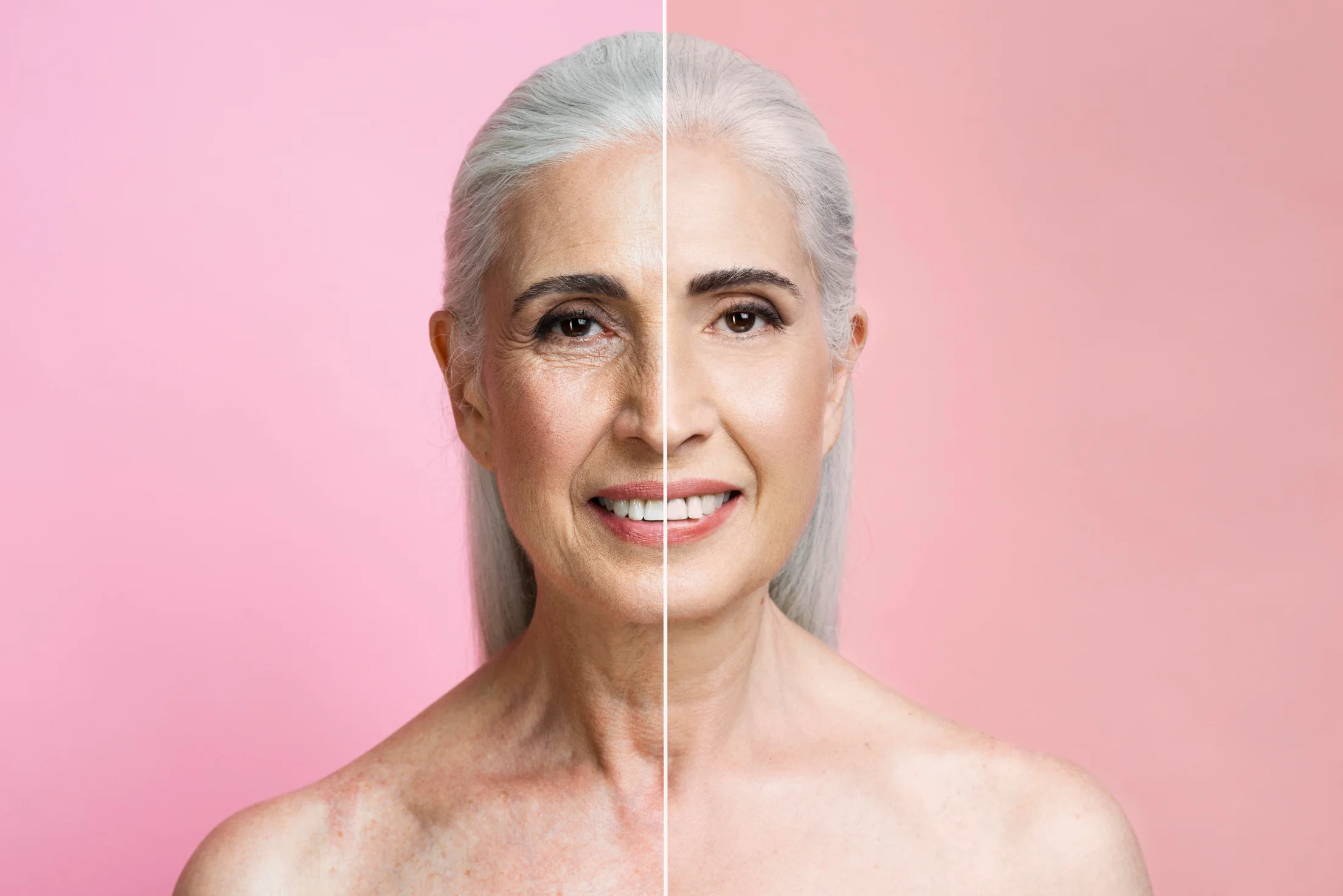 An older woman demonstrates the results after a Profhilo treatment.