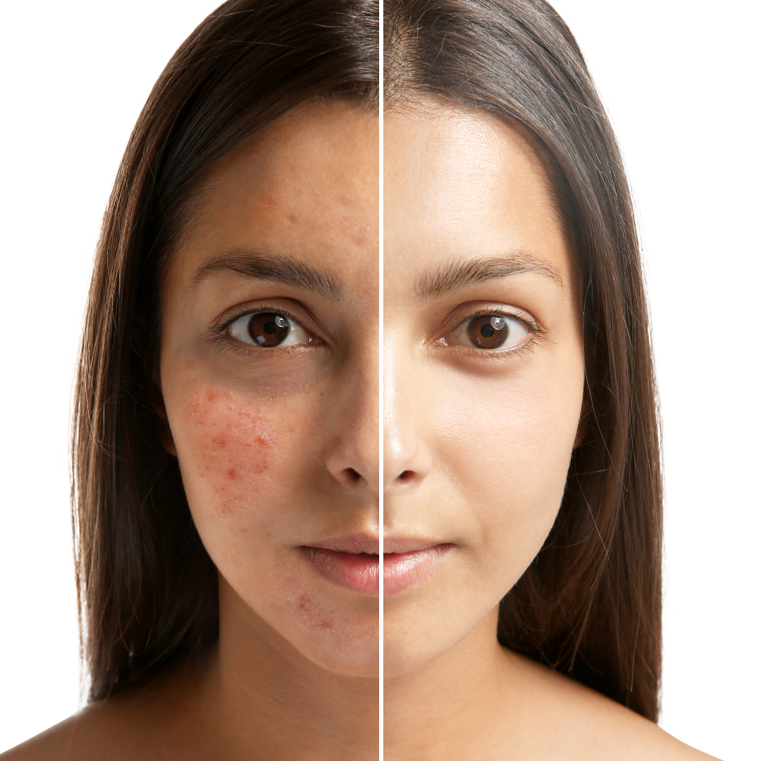 acne before & after