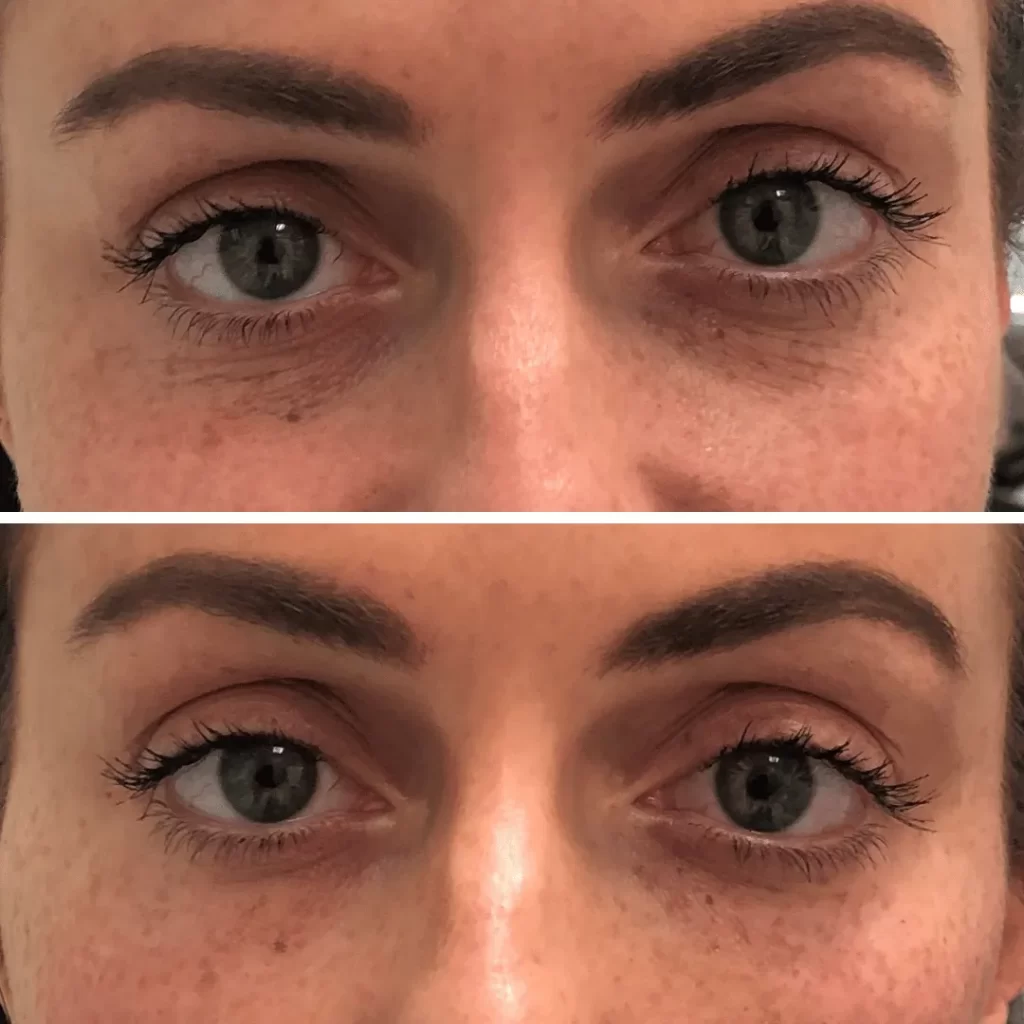 before and after tear trough filler