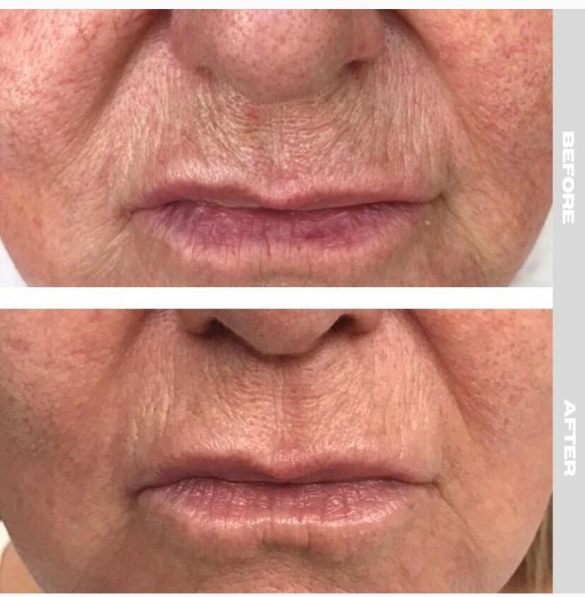 Before & After PRP Therapy