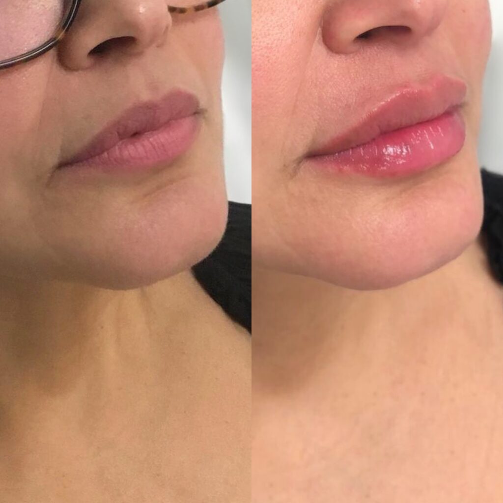 Before & after lip fillers