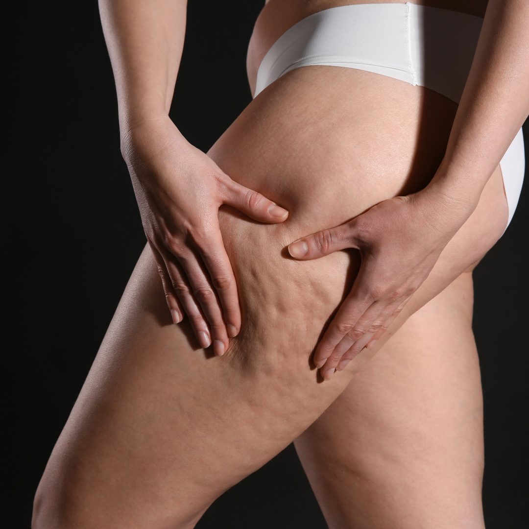 A woman holding with both hands her thigh cellulite.