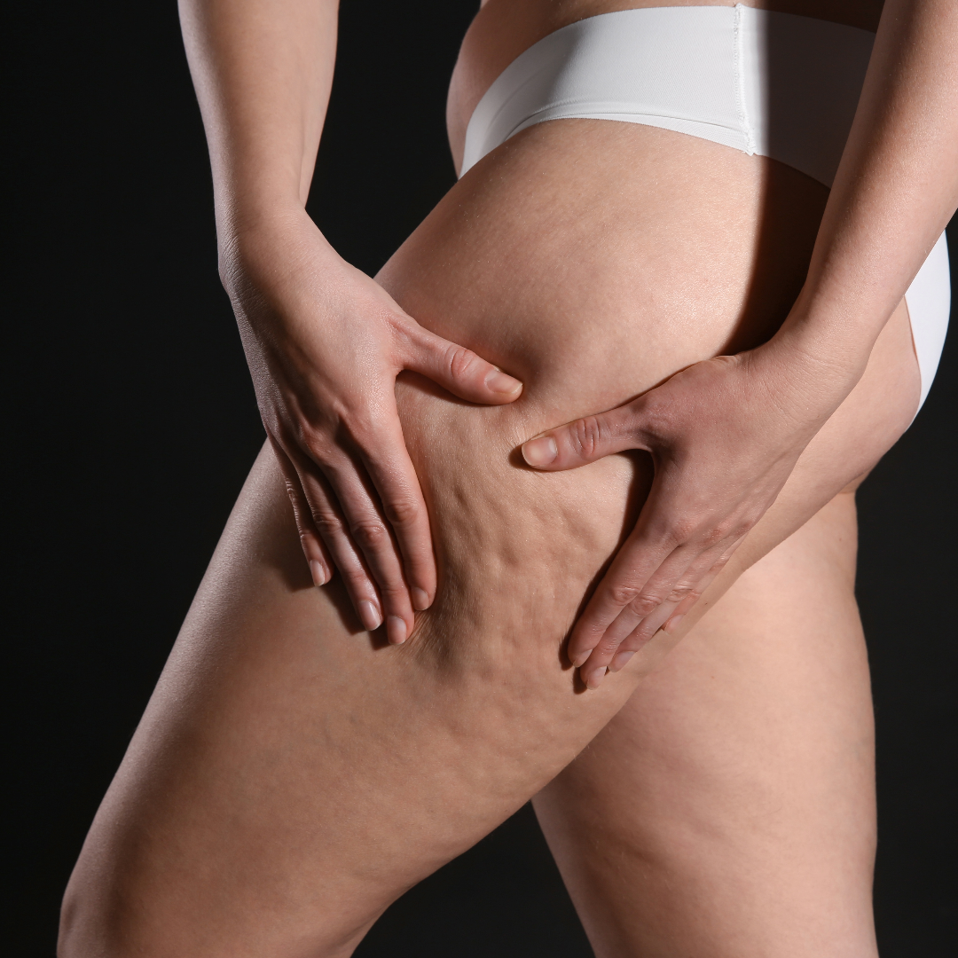 Cellulite treatment