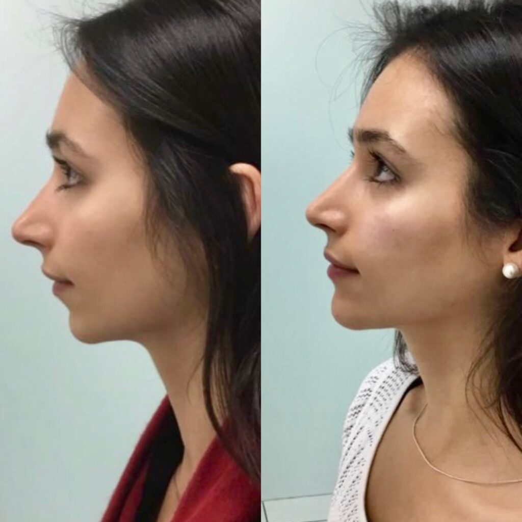 before & after chin filler