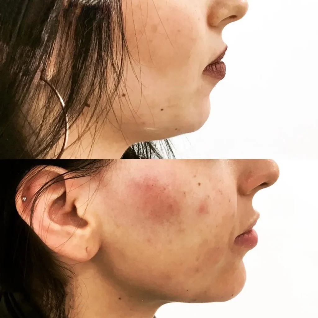 Chin-filler-Before-After