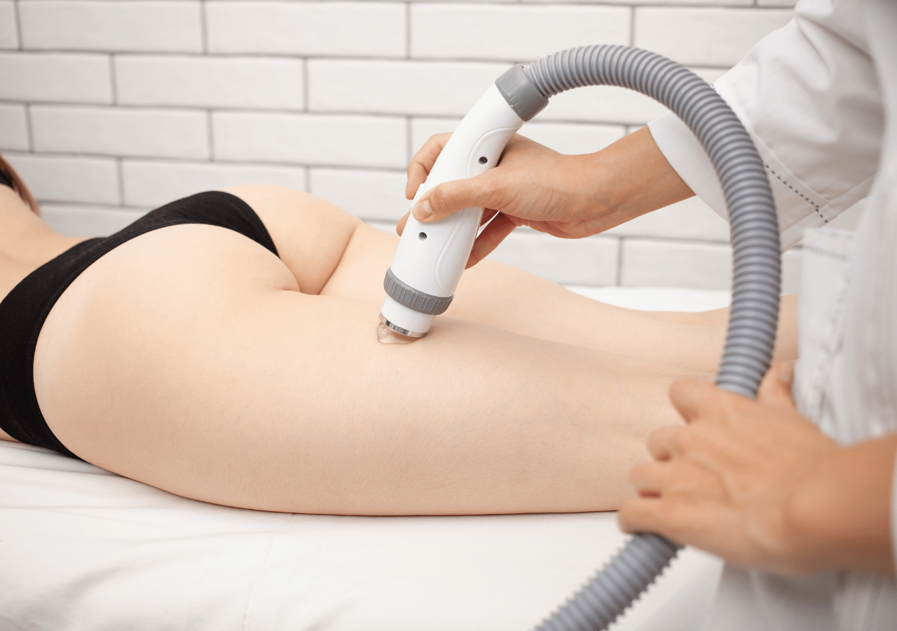 coolsculpting done on the back of the thighs