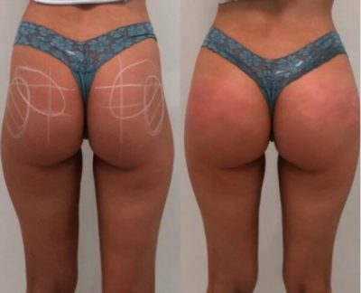 Non-Surgical Butt Lift London & UK, Non-Surgical BBL Price UK