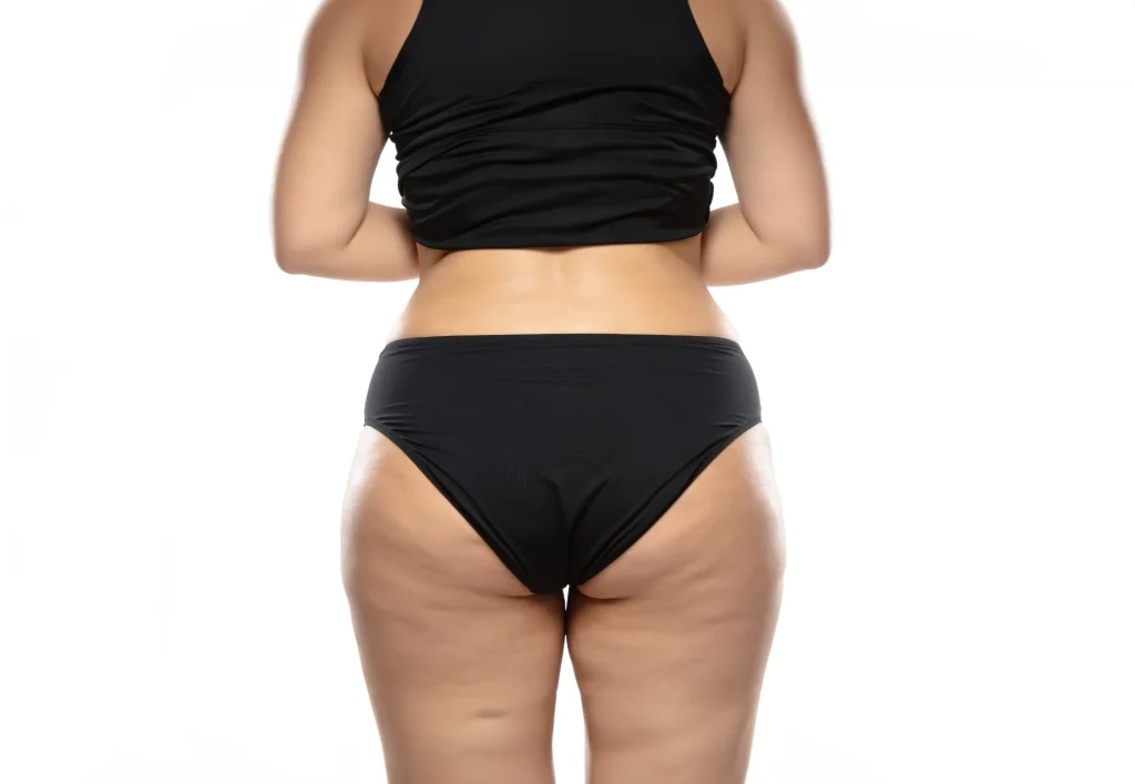 A woman in underwear has cellulite.