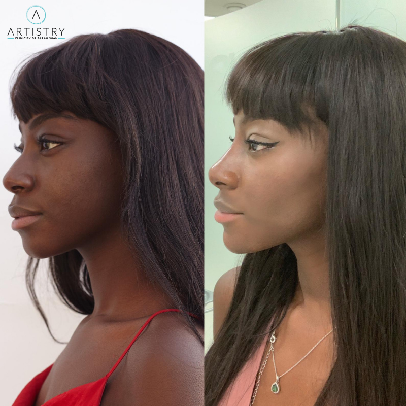 non surgical nose job and chin enhancement before and after
