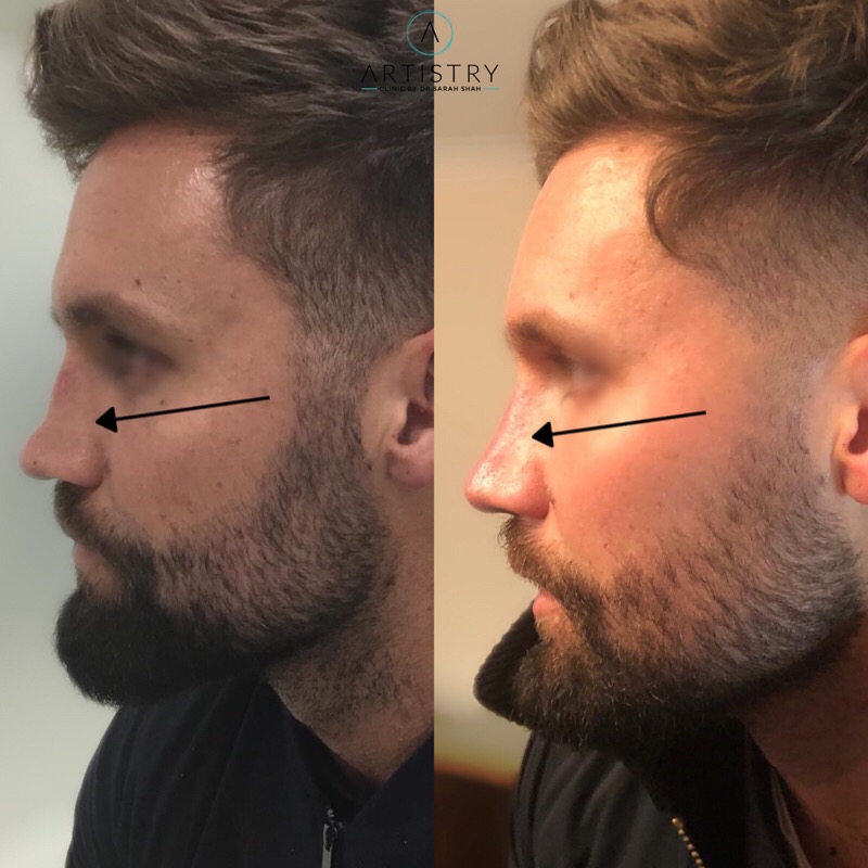 non surgical nose job before and after