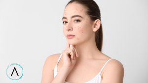 Beautiful woman suffering from acne