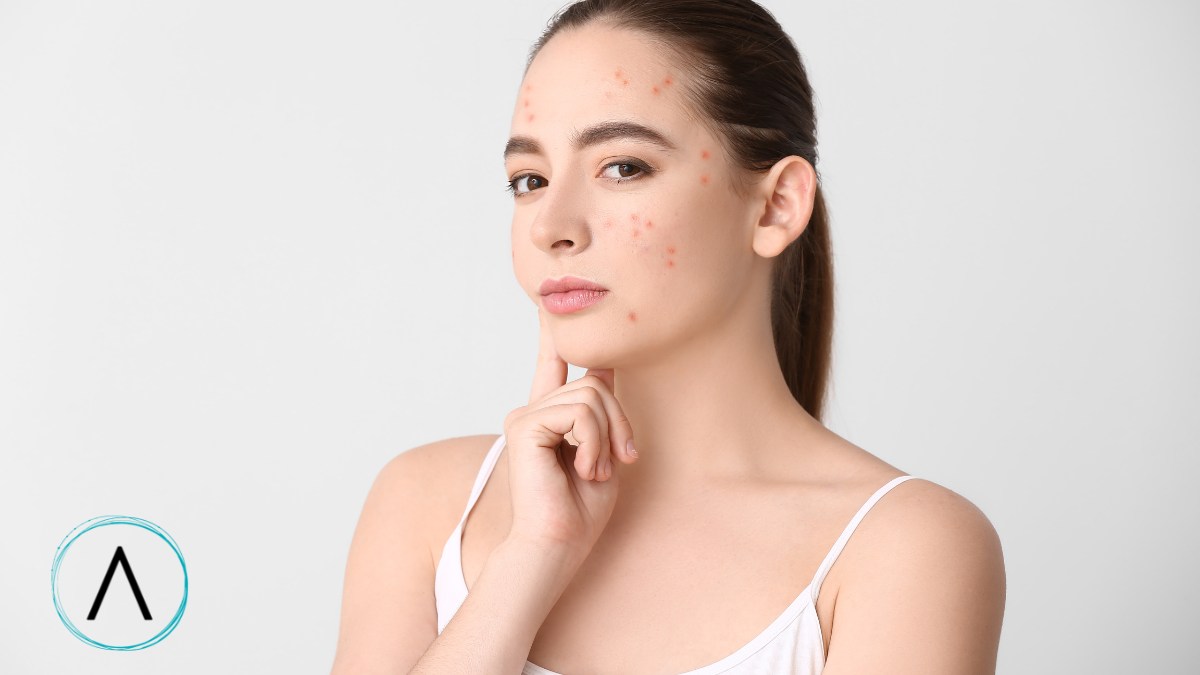 Beautiful woman suffering from acne