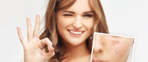 smiling woman after getting rid of acne with obagi