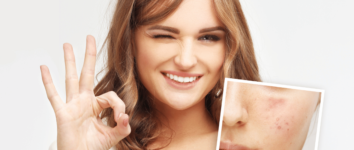 smiling woman after getting rid of acne with obagi