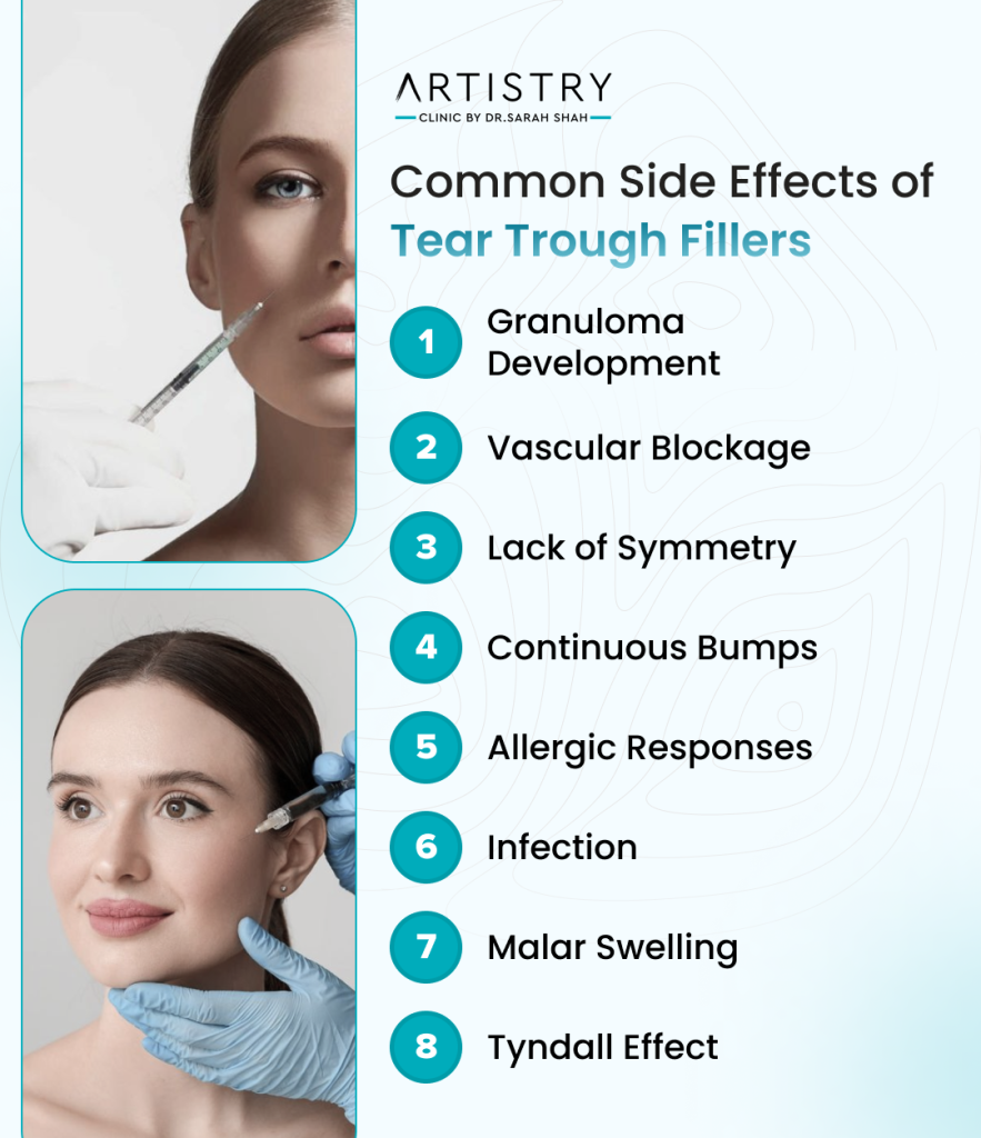 Tear Trough Fillers side effects