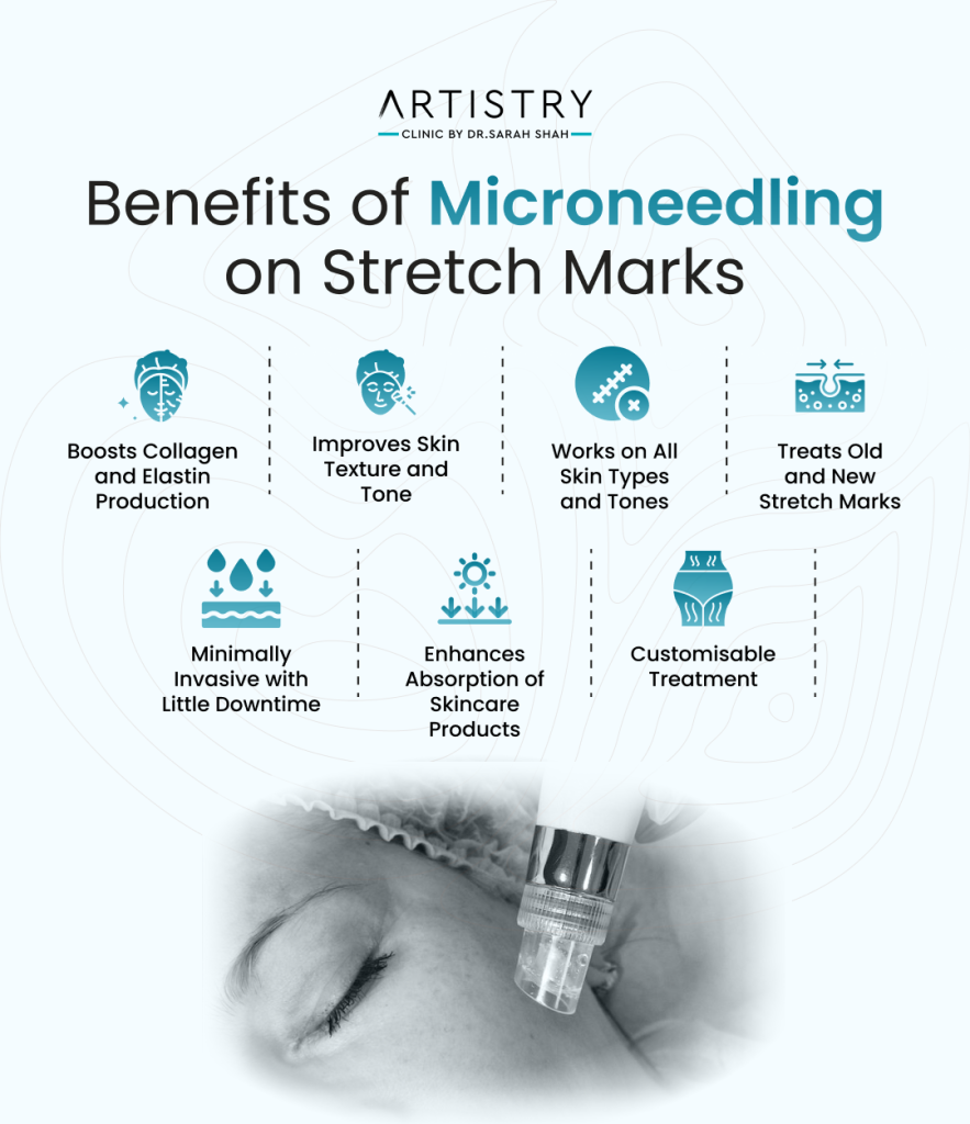 Benefits of Microneedling on Stretch Marks