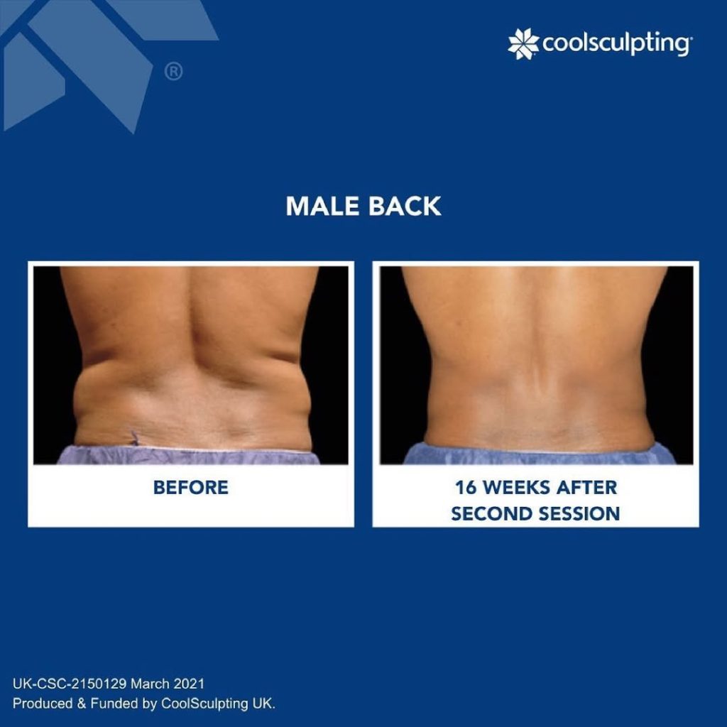 How to Get Rid of Back Fat with Medical Treatments