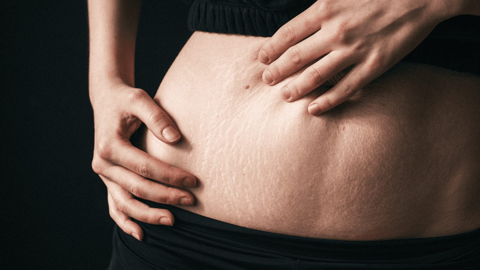 Microneedling for Stretch Marks