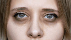 How to Remove Dark Circles Under Eyes Permanently