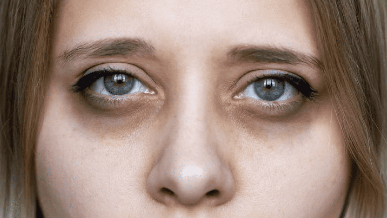 How to Remove Dark Circles Under Eyes Permanently
