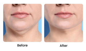 How to Get Rid of Saggy Neck