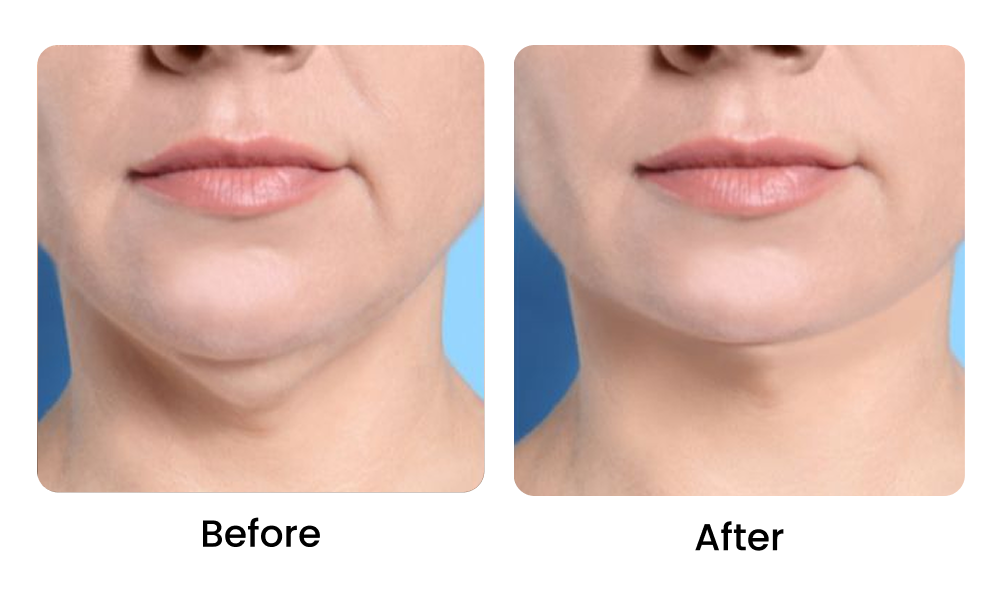How to Get Rid of Saggy Neck
