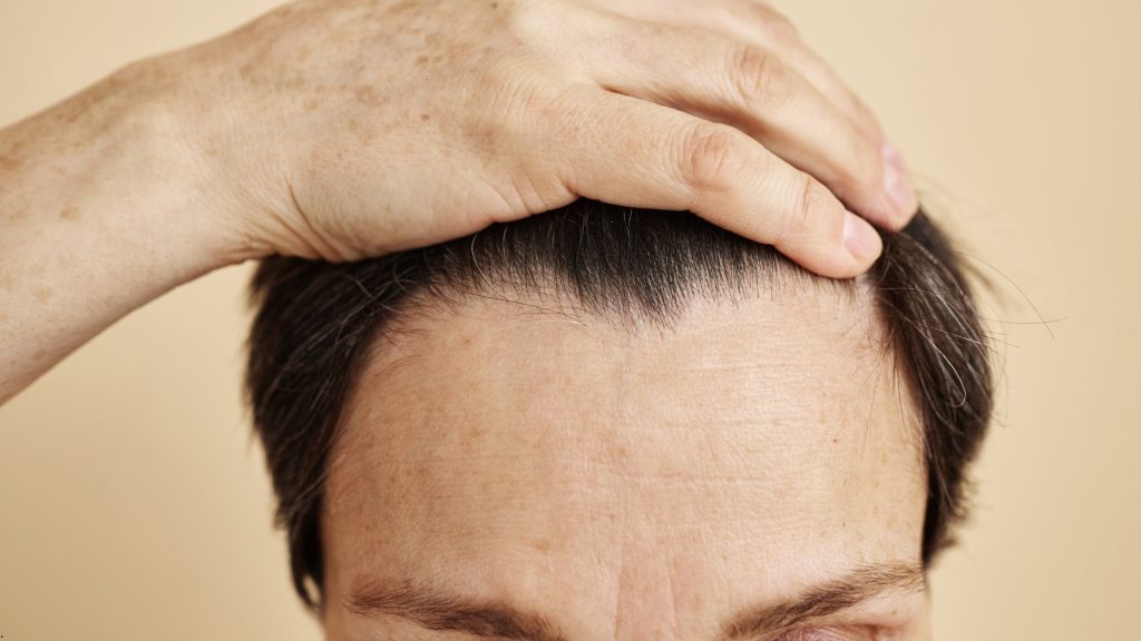 Receding Hairlines