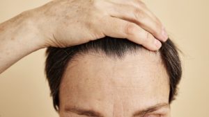 Receding Hairlines