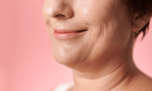 Saggy Jowls