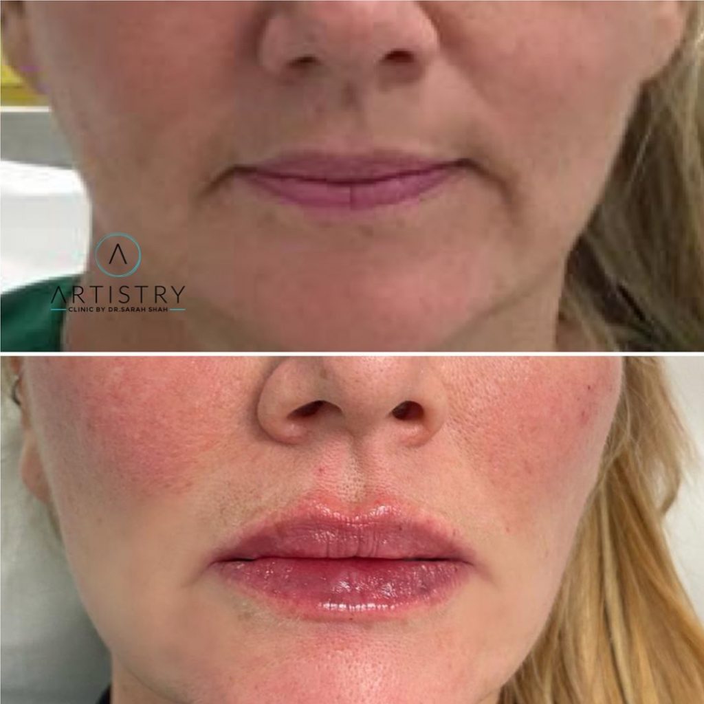 0.5 Lip Filler Before and After