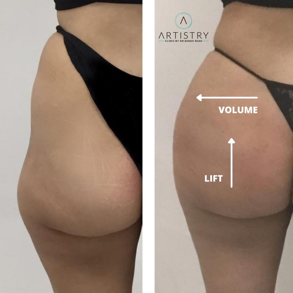Brazilian Butt Lift