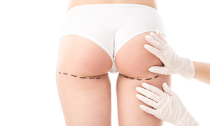 Butt Injections Vs BBL