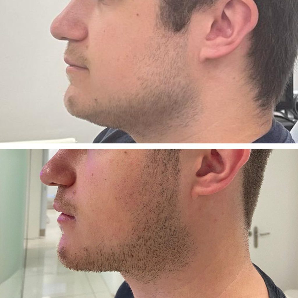 How Does the Botox Treatment Work for Teeth Grinding