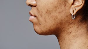 How To Get Rid of Acne Scars
